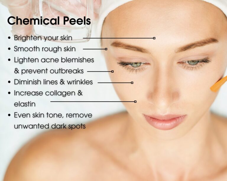 What is a Chemical Peel